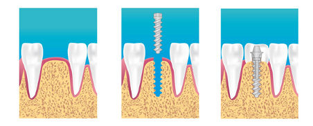 Implants dentaires